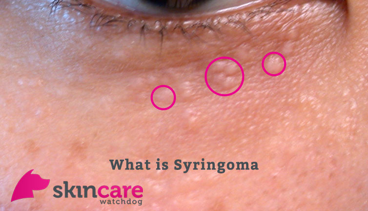 syringomas under eye #11