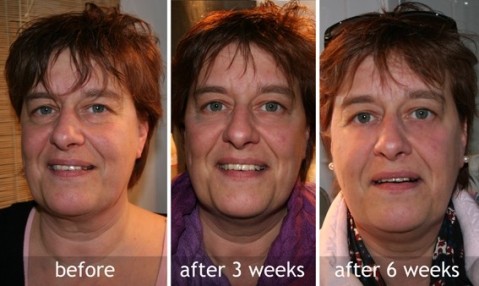 facelift gym before and after