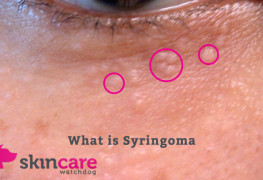 What is Syringoma